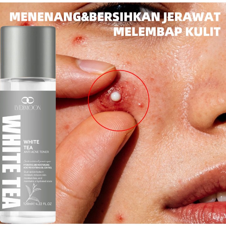 toner wajah toner acne 100ml Melembap kulit Menenang&bersihkan jerawat