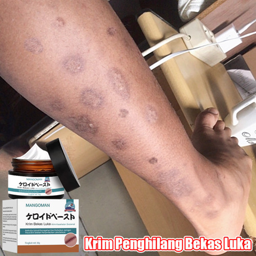 Krim Penghilang Bekas Luka 30g - Hilangkan Hitam, Koreng, Cacar | BPOM Terdaftar